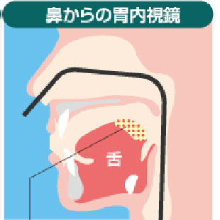 鼻から胃カメラのイメージ